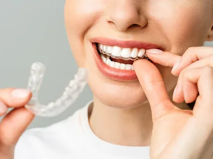 Transparent Teeth Aligners Are Changing Dental Care in Singapore